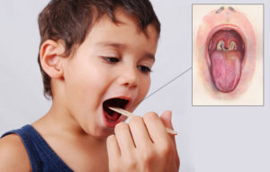 Грибок в горле (кандидоз), грибковая ангина - лечение