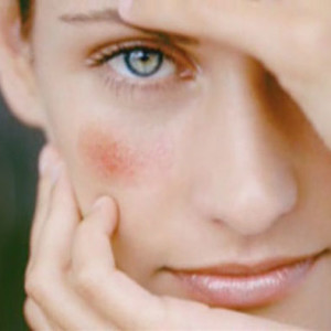 Грибок на лице - лечение и симптомы с фото