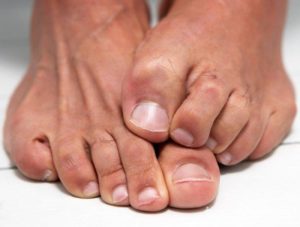 Грибок на пальцах ног - лечение и симптомы с фото