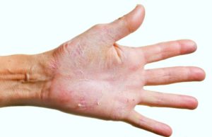 Грибок на пальцах рук: лечение и симптомы с фото