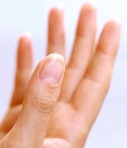 Грибок ногтей на руках симптомы и лечение