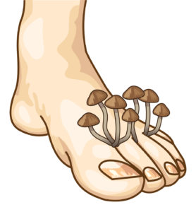 Признаки грибка на ногах - проявление с фото