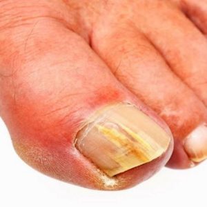 Признаки грибкового поражения ногтей