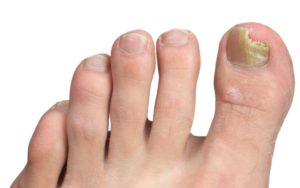 Признаки грибкового поражения ногтей
