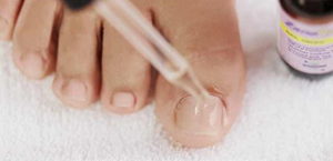 Профилактика грибка ногтей ног