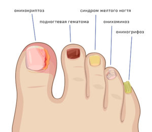 Симптомы грибковых поражений ногтей на ногах