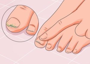 Чем опасен грибок ногтей - если не лечить что будет