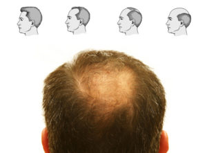 Грибок волос - разновидности, проявления и лечение