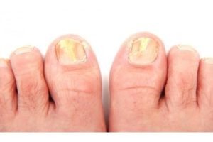 Грибок ногтей при заражении дерматофитами