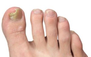 Грибок ногтя на большом пальце ноги - лечение с фото