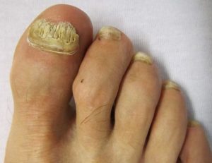 Как яблочным уксусом вылечить грибок ногтей на ногах thumbnail