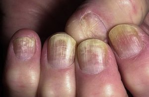 Изменения ногтя при заражении грибами Candida