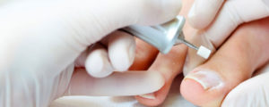 Лечение ногтя на большом пальце