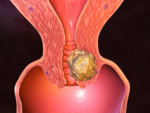 Лечение от грибка половых органов в домашних условиях thumbnail