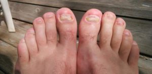 Как вылечить грибок ногтей на ногах микозан thumbnail