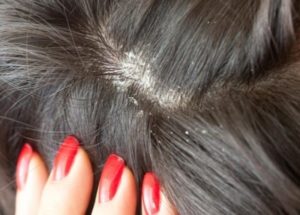 Кожный грибок и выпадение волос thumbnail