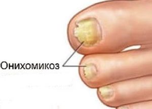 Как вылечить грибок ногтей на ногах уксусом в домашних thumbnail