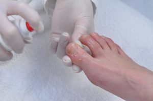 Болезни на коже на пальцах ног thumbnail